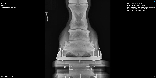 Right Forefoot DP